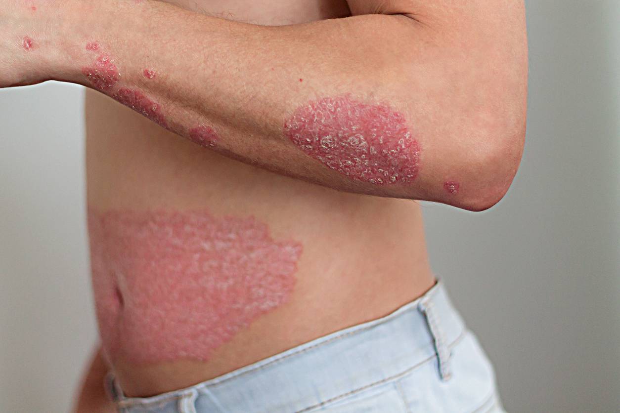 psoriasis maladie peau traitement naturel rougeurs