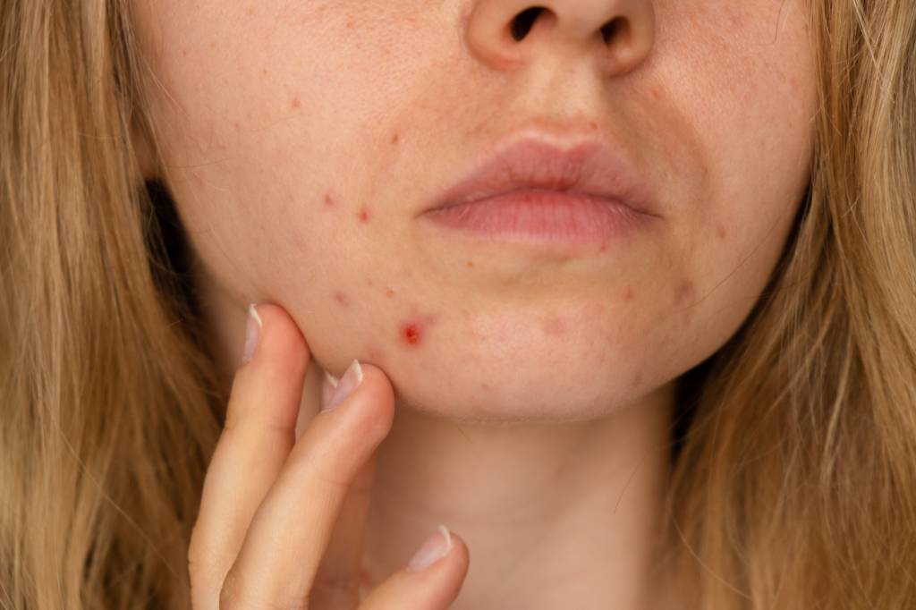 imperfections tendance acnéique causes boutons cosmétiques